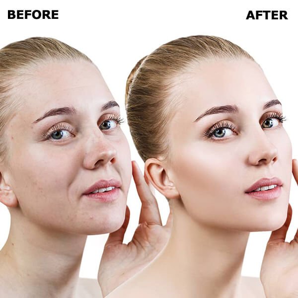 face-lifting
